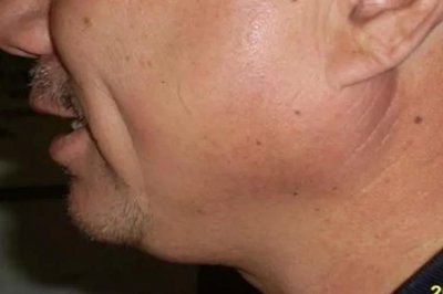 ​腮腺炎的症状图片