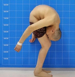 ​身体被敲断4次，打入22根钢钉，他“折叠”28年，如今重获新生